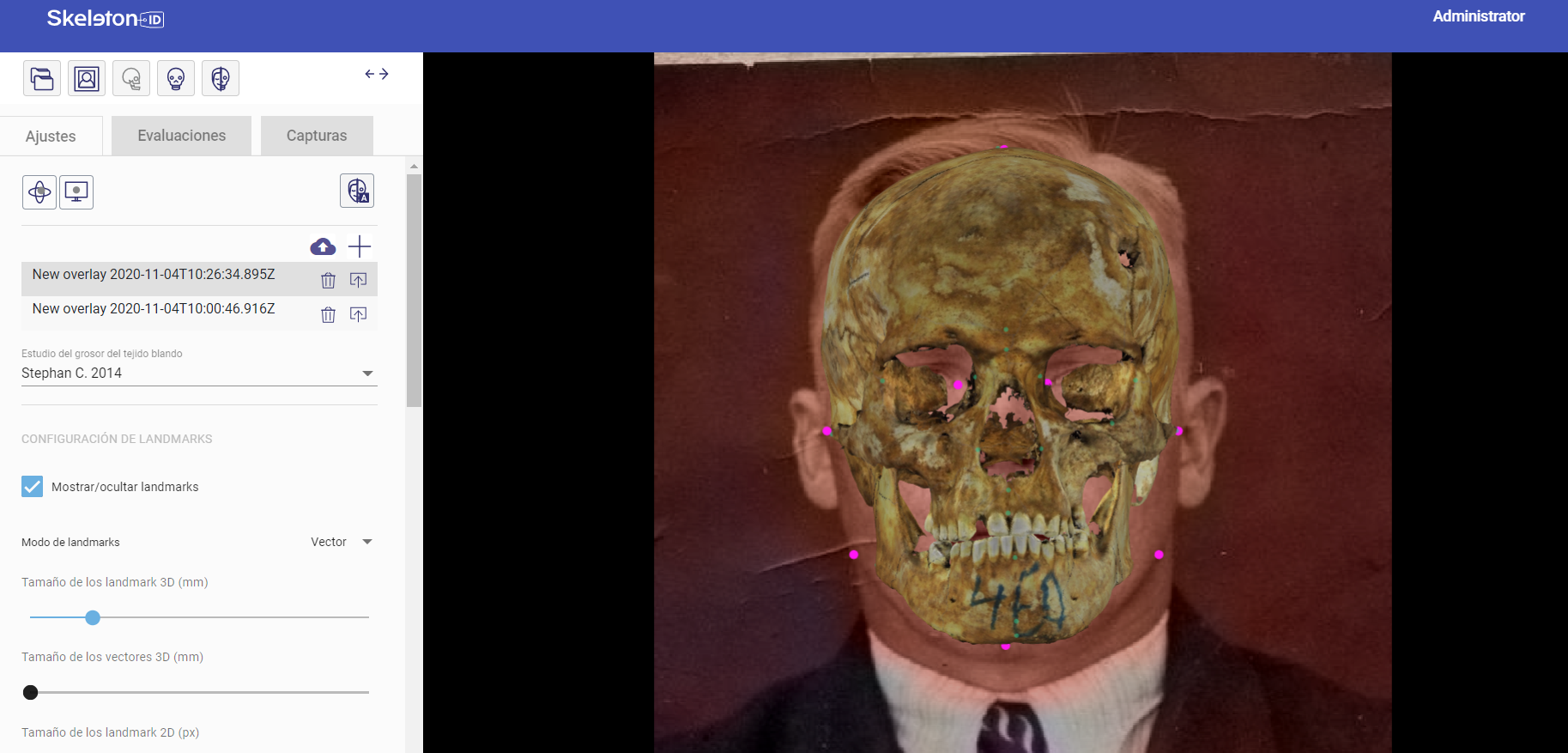 Solapamiento cráneo-cara obtenido mediante el algoritmo POSEST-SFO